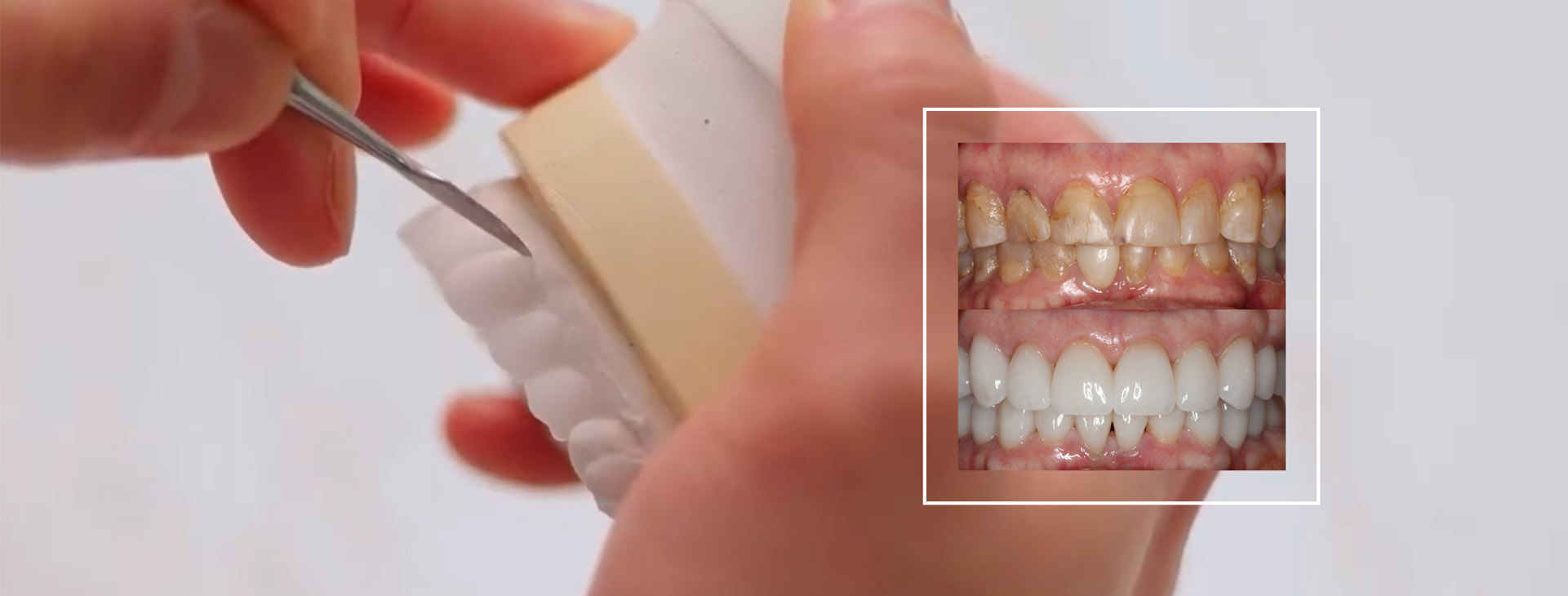 Smile Brighter for Half the Price