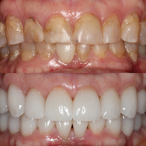 Image of Veneers